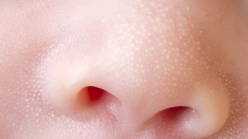 Phân loại mụn hạt kê ở trẻ sơ sinh