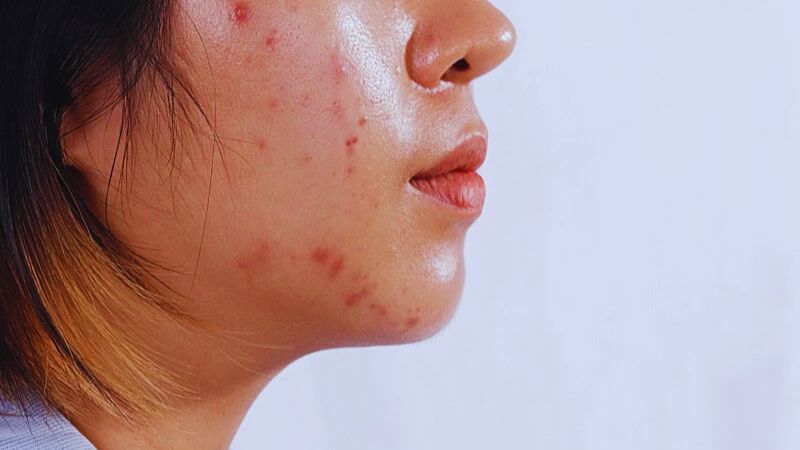 Đối tượng sử dụng sữa rửa mặt Floslek Anti Acne Face Cleansing