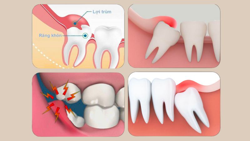 Biểu hiện của viêm lợi trùm răng khôn