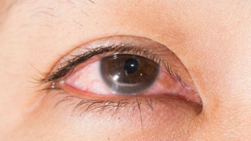 Nguyên nhân khiến mắt mờ sau khi đau mắt đỏ