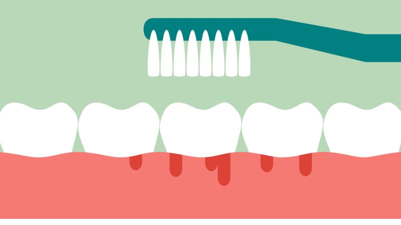 Biểu hiện răng bị tụt lợi