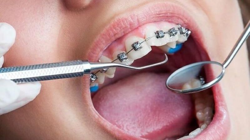 Vì sao cần siết răng định kỳ?