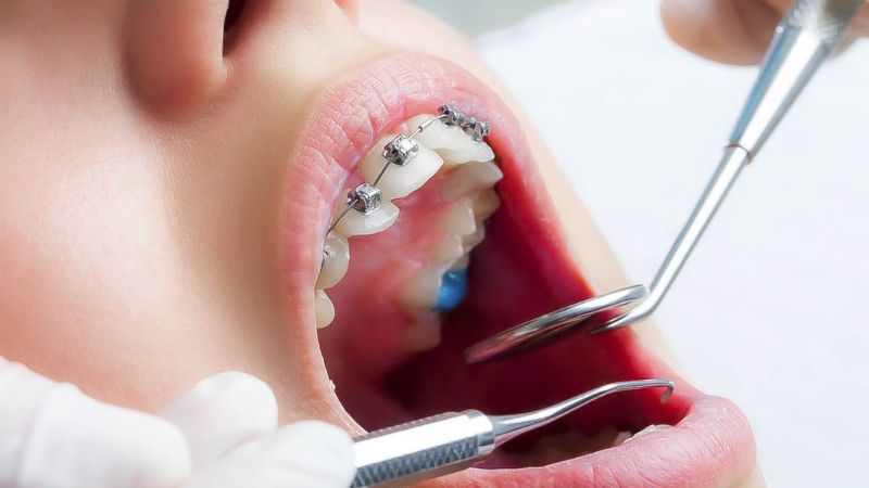 Niềng răng bao lâu siết một lần?