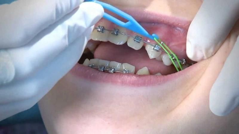 Siết răng khi niềng có đau không?