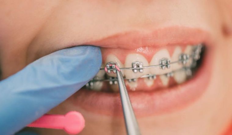 Niềng răng bao lâu siết một lần? Cách giảm đau sau khi siết răng