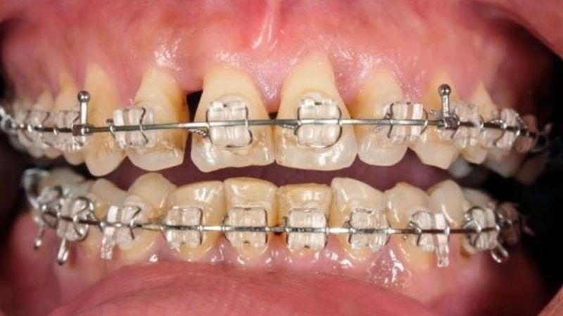 Tụt lợi sau quá trình niềng răng