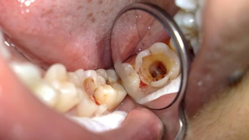 Đau hàm, răng chết tủy do niềng răng