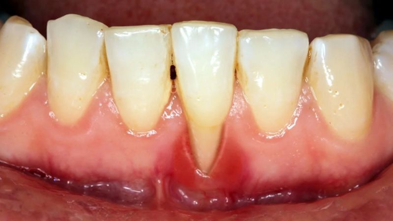 Chân răng bật ra khỏi xương hàm, tiêu cụt chân răng