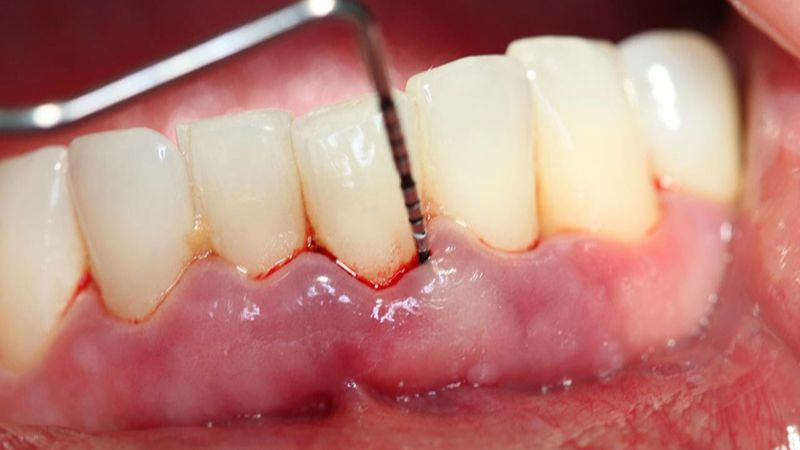 Nhiễm trùng nướu gây viêm nha chu dẫn, sâu răng