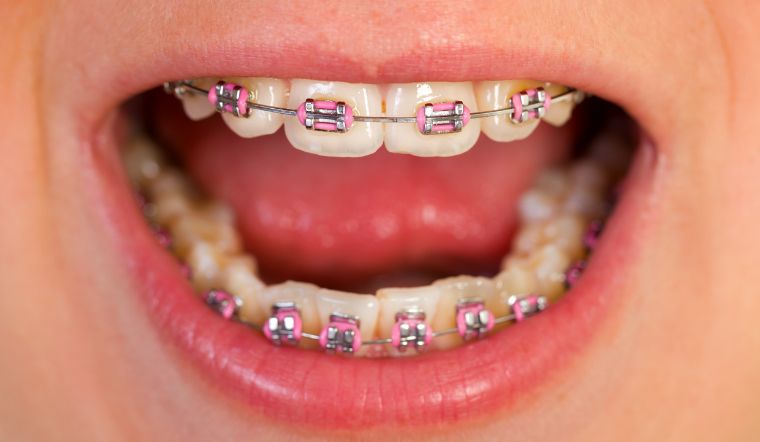 Dấu hiệu và cách khắc phục niềng răng hỏng bạn không nên bỏ qua