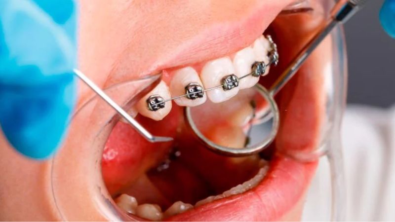 Niềng răng hô có phải nhổ răng không?
