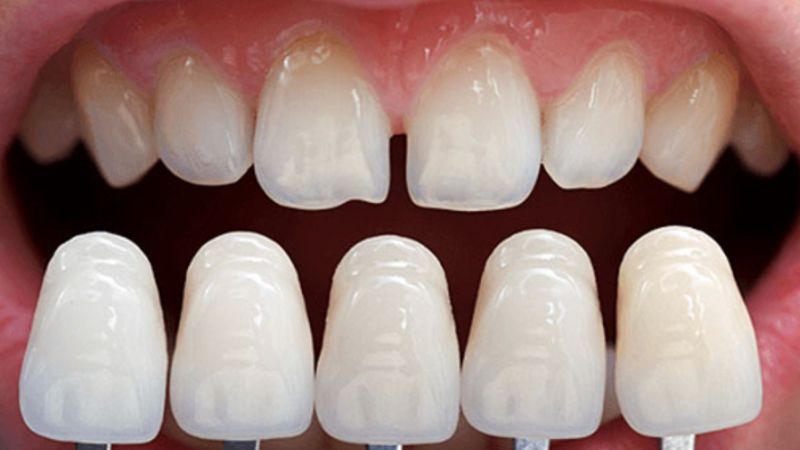 Loại răng sứ phù hợp để bọc răng cửa