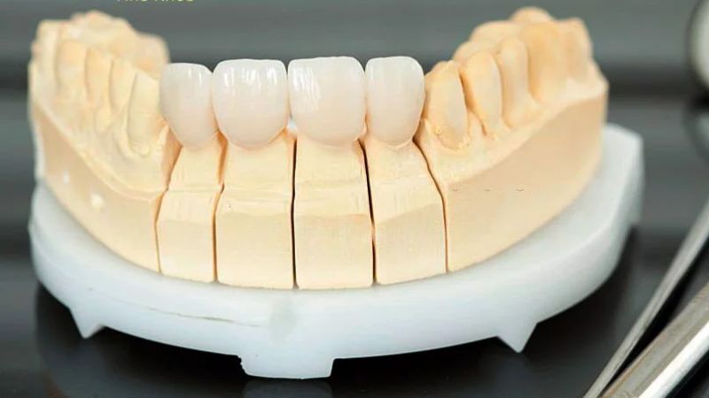 Vì sao nên bọc răng sứ 4 răng cửa thay vì 2 răng?
