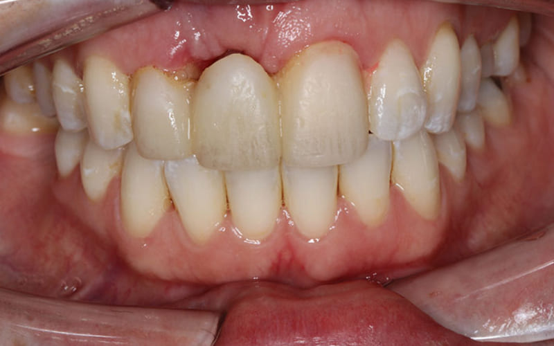 Nguyên nhân răng sứ bị hở chân răng