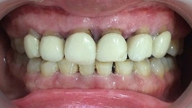 Những tác hại khi răng sứ bị hở chân răng