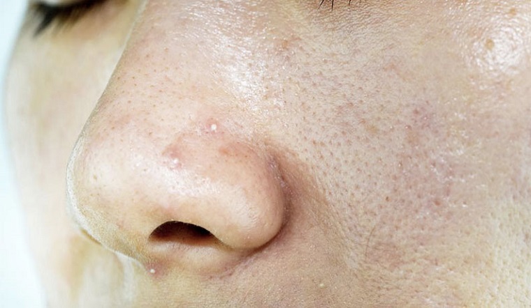 Sebum là gì? Tìm hiểu về No Sebum và Phức hợp Anti sebum P' trong mỹ phẩm