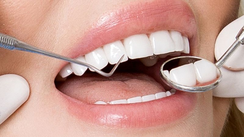 Vì sao bọc răng sứ còn phải niềng răng