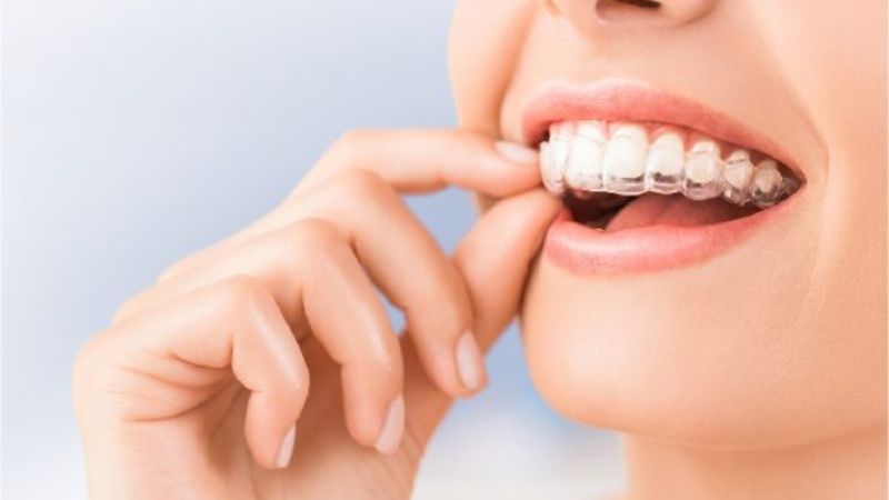 Phương pháp niềng răng phù hợp sau khi bọc răng sứ