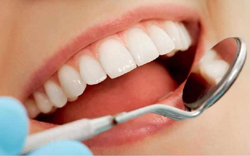 Thời gian bọc răng sứ lần 2 mất bao lâu?