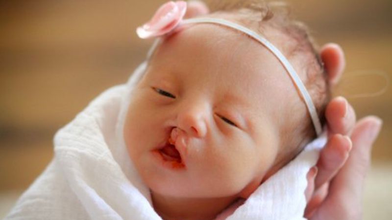 Điểm qua 4 loại dị tật bẩm sinh phổ biến ở trẻ sơ sinh bố mẹ cần biết