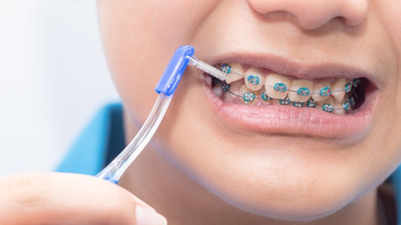 Bàn chải kẽ răng là gì? Cách sử dụng bàn chải kẽ cho người niềng răng