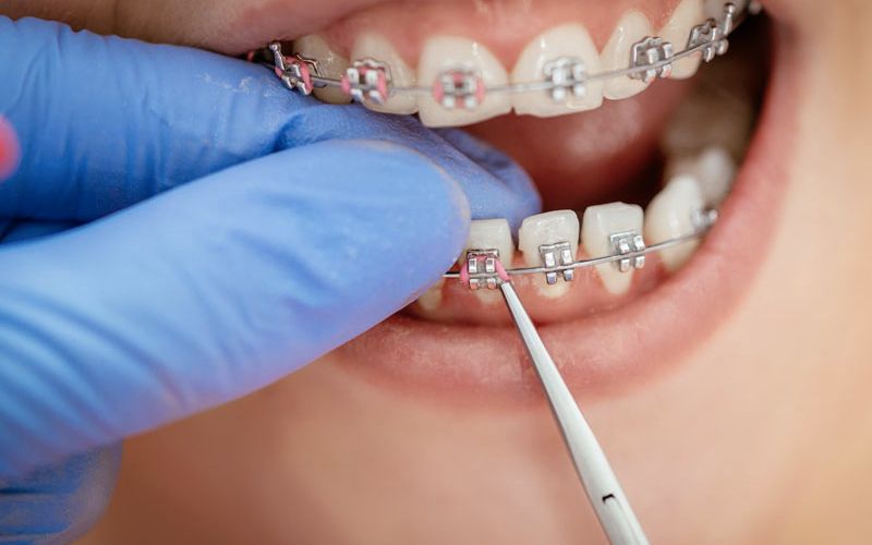 Niềng răng ở địa chỉ nha khoa kém chất lượng có thể gây ố vàng dây thun