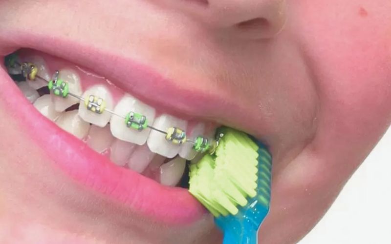Sử dụng bàn chải lông mềm giúp ngăn ngừa dây thun niềng răng bị vàng