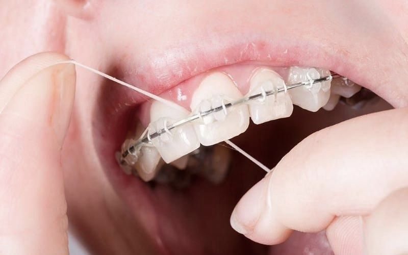 Sử dụng chỉ nha khoa giúp dây thun niềng răng ít bị ố vàng