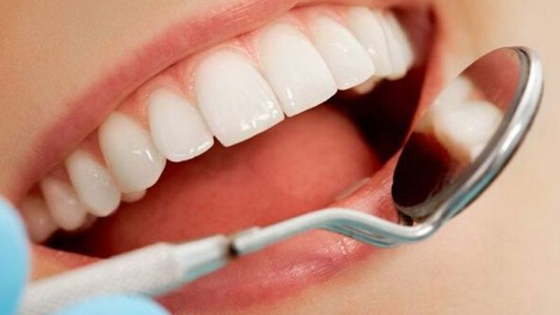 Răng sứ Mỹ là gì?