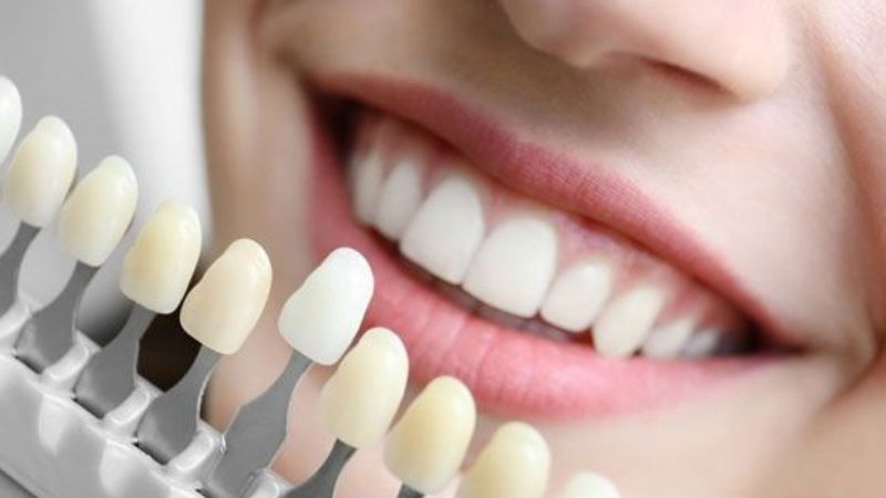 Răng sứ Ceramill có tốt không?