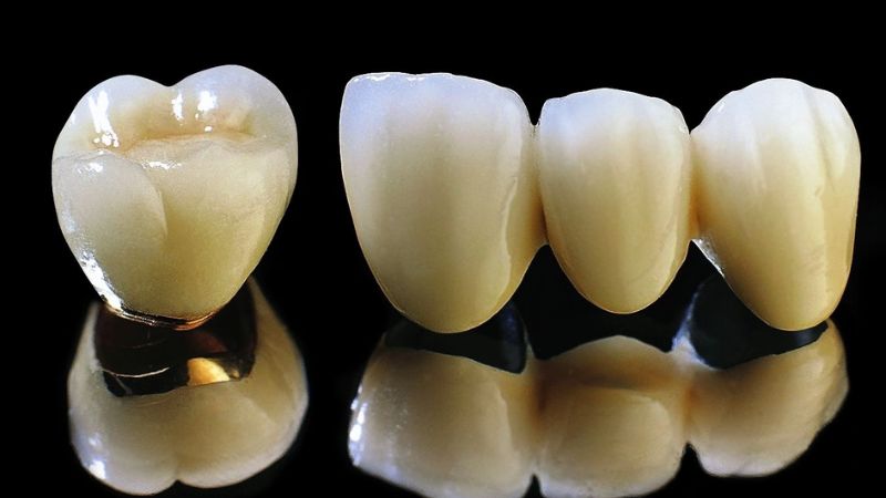 Răng sứ Titan là gì?
