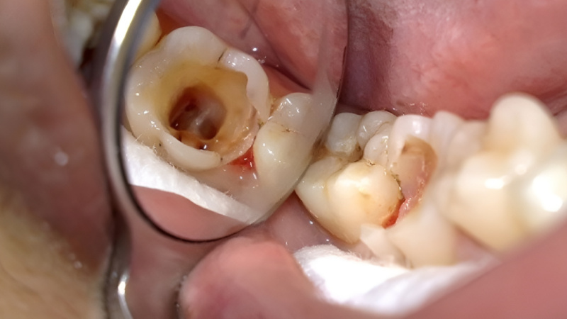 Khi tủy răng chết, răng sẽ không còn khả năng cảm nhận cảm giác đau nhức