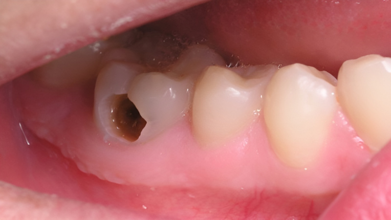 Sâu răng là nguyên nhân hàng đầu gây chết tủy răng
