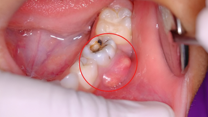 Răng chết tủy có thể tồn tại trong một thời gian ngắn