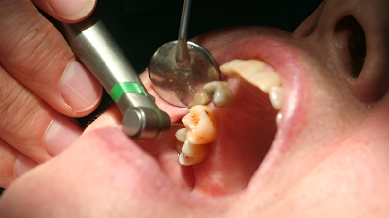 Cách điều trị răng chết tủy hiện nay