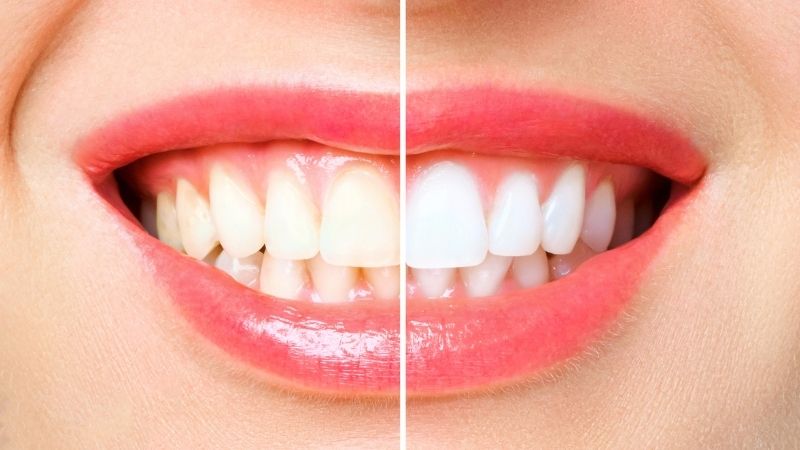 Bao lâu nên tẩy trắng răng 1 lần?