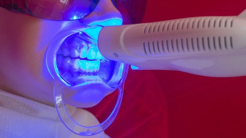 Tẩy trắng răng nhiều lần có hại không?