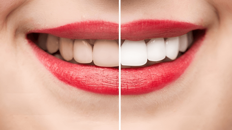 Có nên dùng bột tẩy trắng răng tại nhà không?