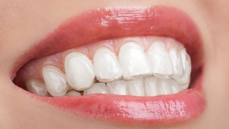 Vì sao sau khi tẩy trắng răng cần kiêng ăn?