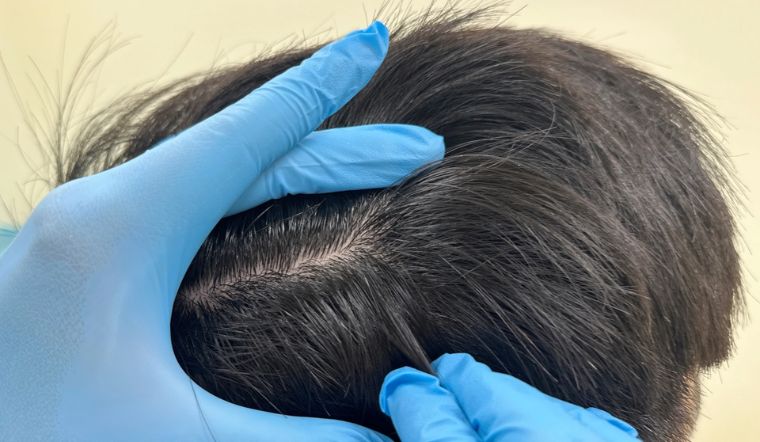 Thói quen nhổ tóc sâu có gây hại cho da đầu hay không?