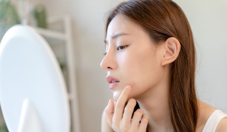 Khi bị mụn trứng cá, phụ nữ mang thai nên tránh xa các hoạt chất này