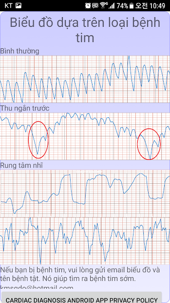 Screenshots Chẩn đoán tim (loạn nhịp tim): Đo nhịp tim bằng camera