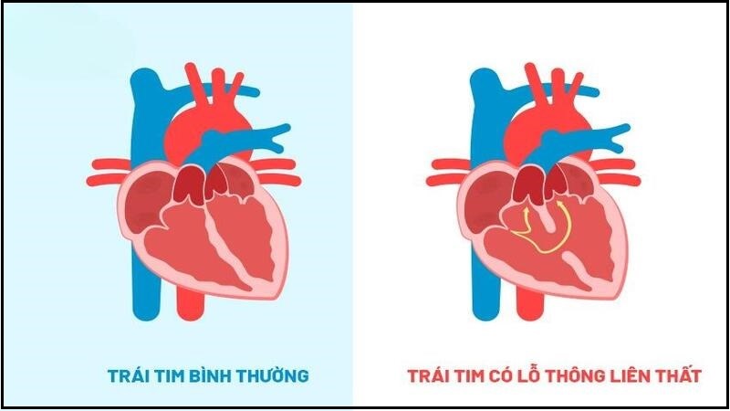 Hội chứng Eisenmenger thường gặp ở trẻ em và thanh thiếu niên có thông liên thất chưa được điều trị.