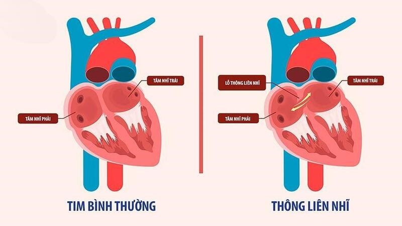 Hội chứng Eisenmenger xảy ra khi người bệnh có những khiếm khuyết các cấu trúc của tim.