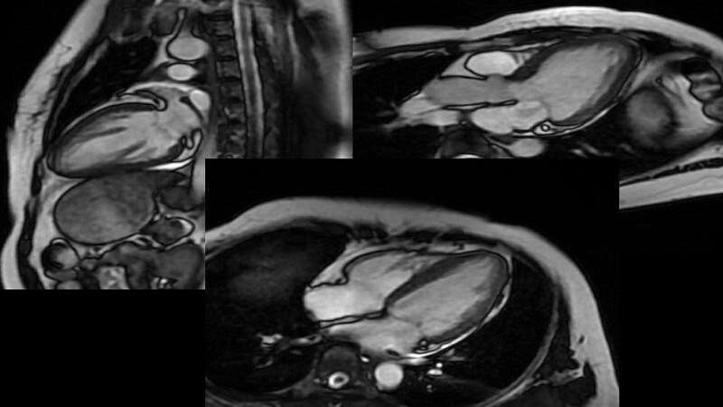 Chụp MRI tim giúp đánh giá những bất thường cấu trúc tim