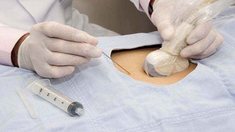 Tăng sản thượng thận bẩm sinh có thể được chẩn đoán trước sinh nhờ phương pháp chọc ối Tăng sản thượng thận bẩm sinh có thể được chẩn đoán trước sinh nhờ phương pháp chọc ối