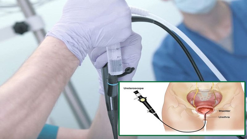 Nội soi bàng quang giúp phát hiện những tổn thương niêm mạc bàng quang