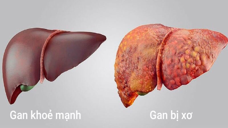 Bệnh nhân xơ gan có nguy cơ cao bị rối loạn điện giải
