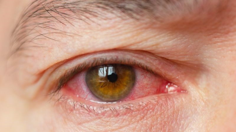Khô mắt có thể gây ra nhiễm trùng mắt