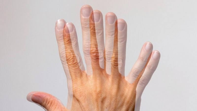 U tuyến tùng có thể dẫn tới nhìn đôi U tuyến tùng có thể dẫn tới nhìn đôi